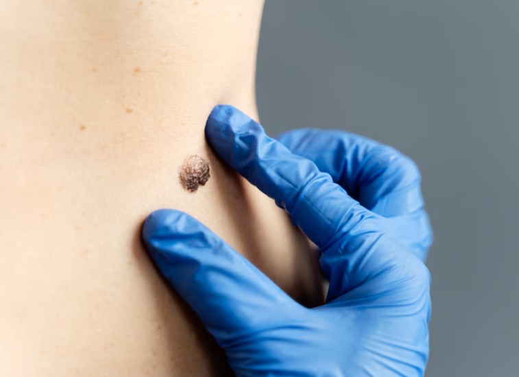 Mole Removal treatment